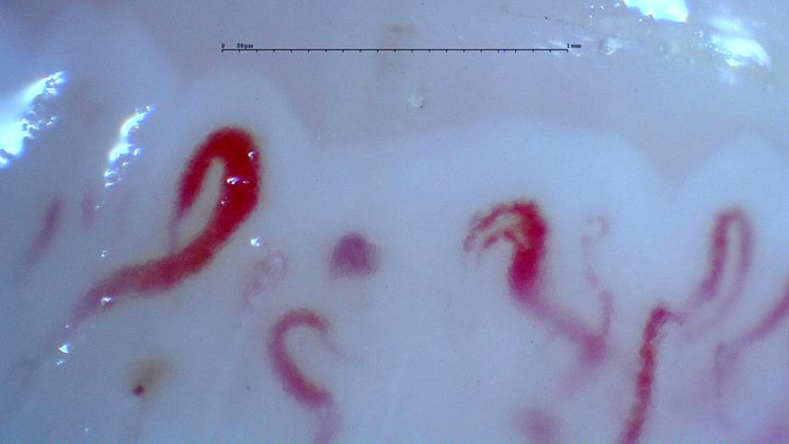 A giant-appearing capillary on the left and other asymmetrically enlarged loops. A small reddish-brown deposit below may represent a microhemorrhage.
