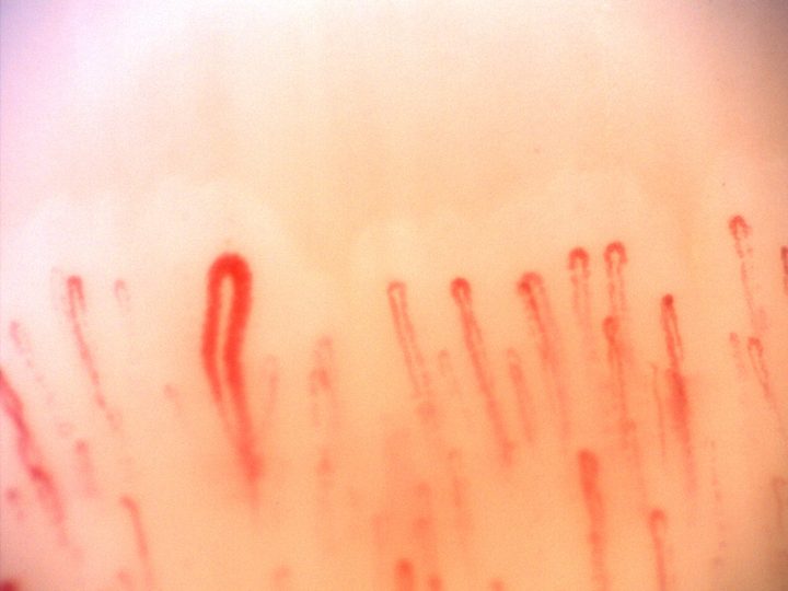 An enlarged capillary with a simple hairpin shape left of center, surrounded by finer loops.
