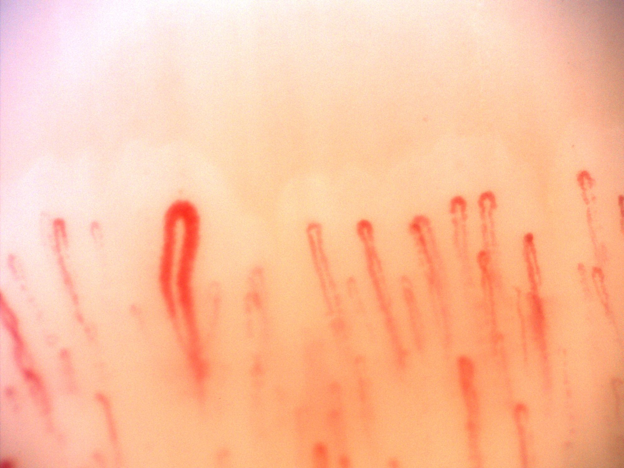 An enlarged capillary with a simple hairpin shape left of center, surrounded by finer loops.