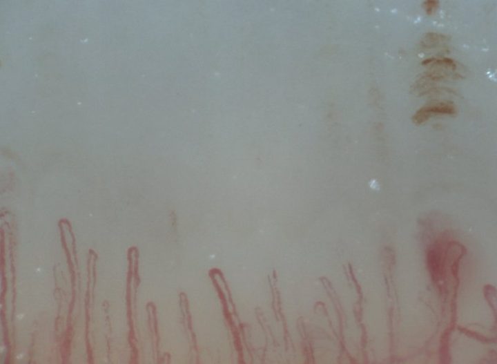 Slender hairpin capillaries with several elongated brown hemorrhagic deposits above the right side.