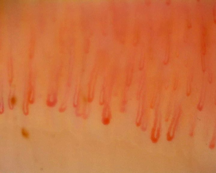 Long hairpin capillaries with some enlarged rounded apices. Small brown deposits compatible with microhemorrhages lie near the lower left.