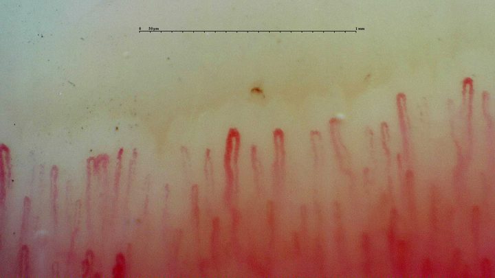 Hairpin capillaries of different widths with a small curved brown deposit compatible with a microhemorrhage above the center.