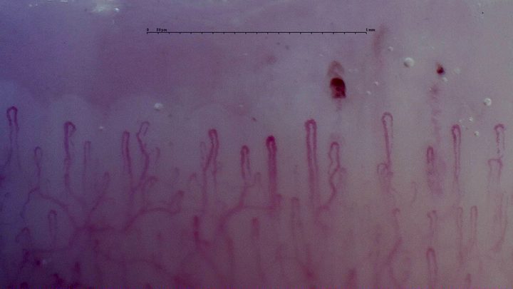 Mostly fine hairpin capillaries with two separate dark red microhemorrhages above the row.
