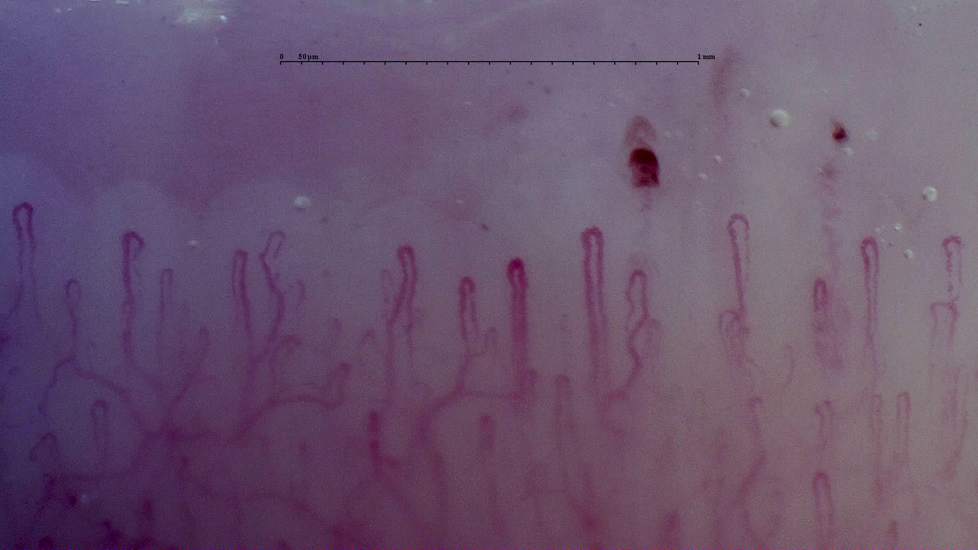 Mostly fine hairpin capillaries with two separate dark red microhemorrhages above the row.