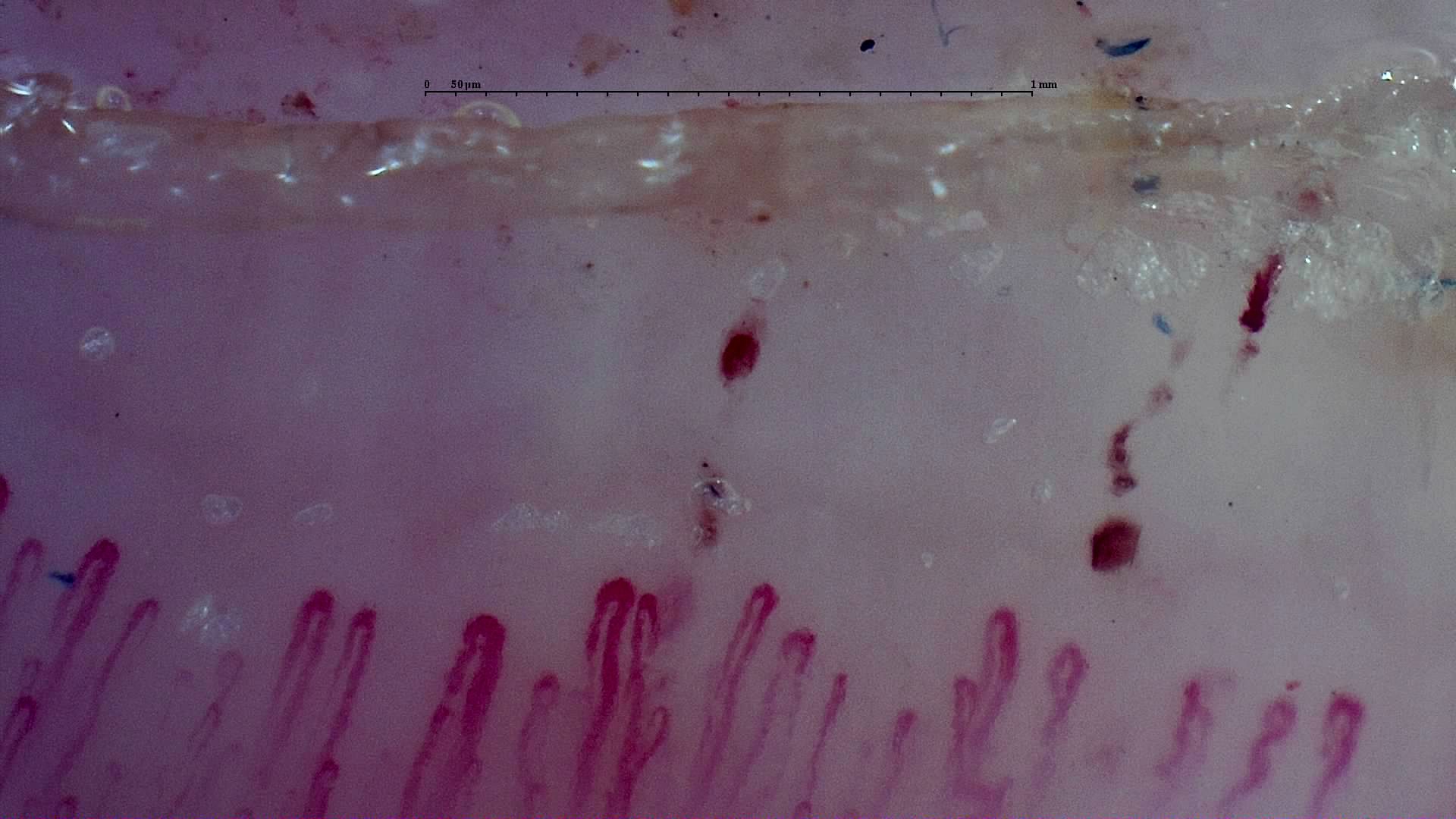 Enlarged hairpin capillaries and some tortuous loops. Several dark hemorrhagic deposits form short rows above them.