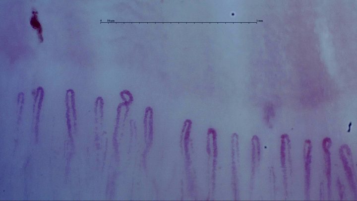 Mostly simple hairpin capillaries with one small coiled apex. An isolated elongated hemorrhage lies above the left side.