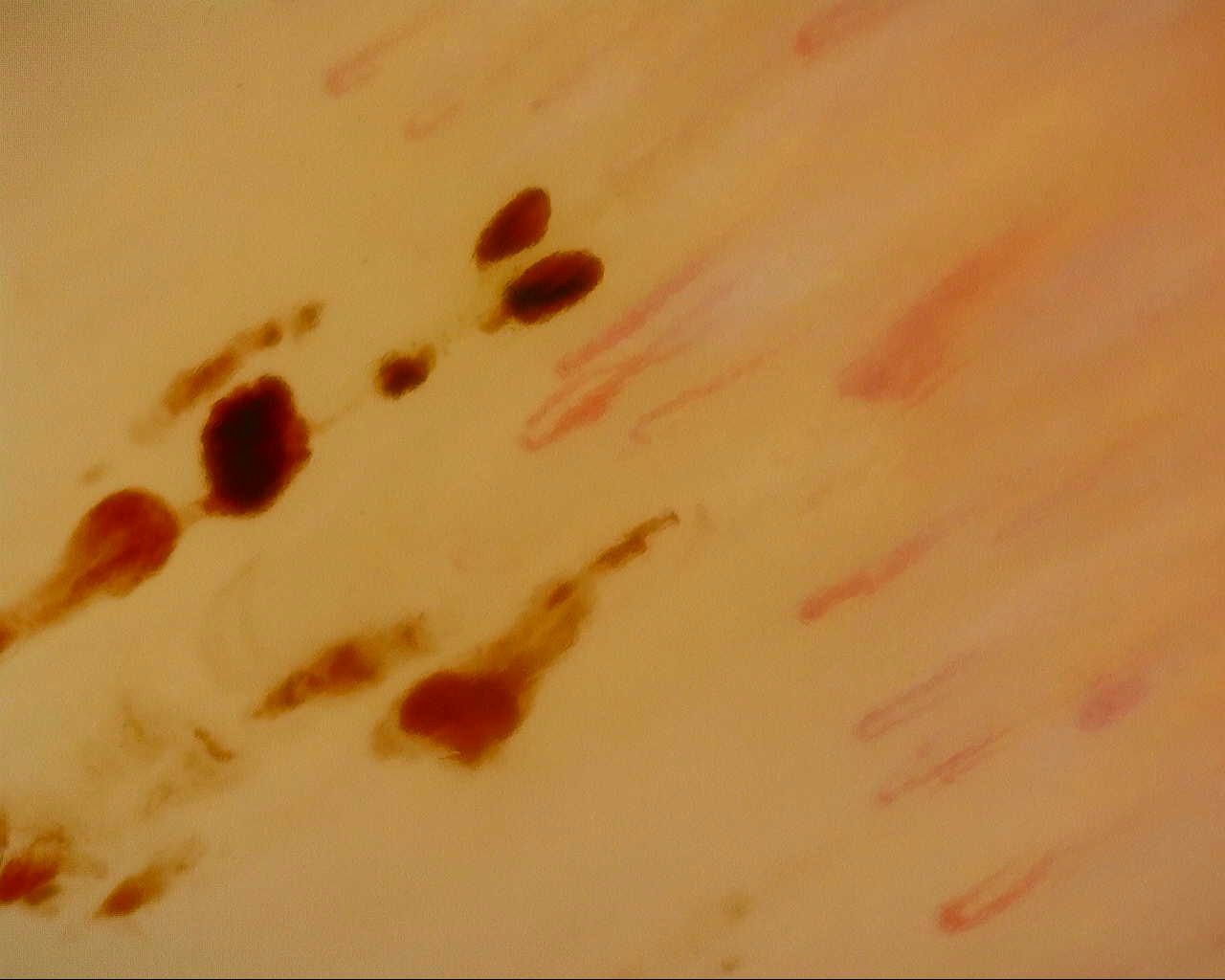Fine elongated capillaries with numerous brown-red hemorrhagic deposits of different sizes.