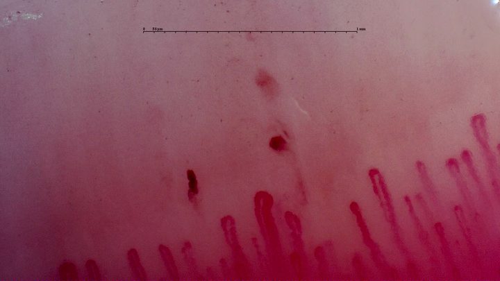 Capillaries with enlarged rounded apices and three separate reddish hemorrhagic deposits above the row.