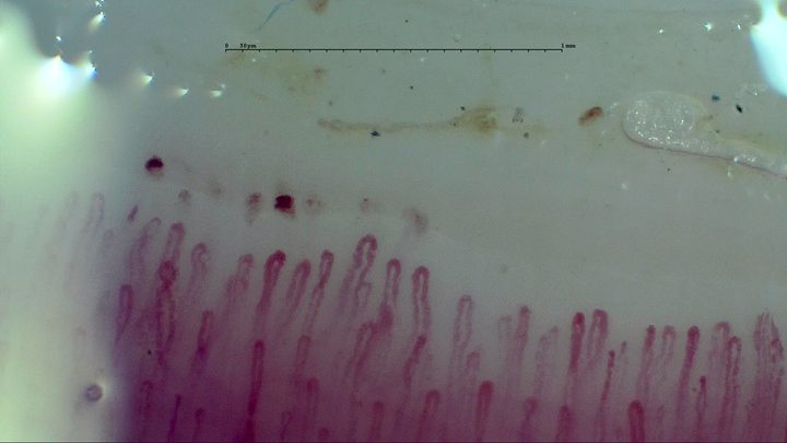 Elongated hairpin capillaries of different widths, with several small microhemorrhages above the left half.