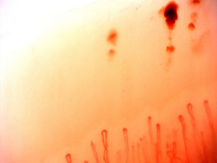 Slender capillary loops with a large dark red hemorrhagic deposit and smaller nearby foci at the upper right.