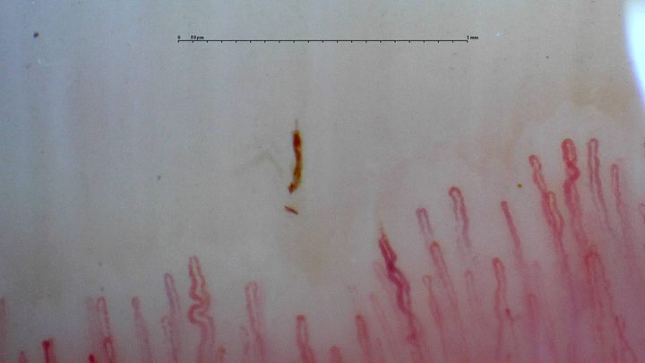 Tortuous capillaries mixed with finer rounded hairpin loops. A thin brown hemorrhagic deposit lies above the center.
