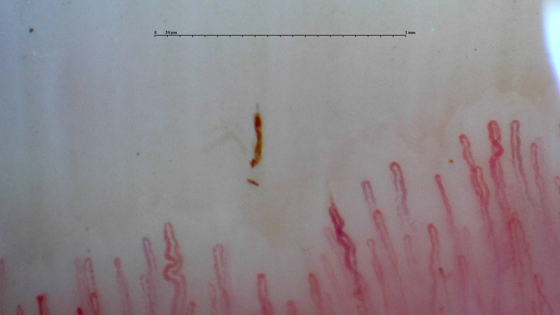 Tortuous capillaries mixed with finer rounded hairpin loops. A thin brown hemorrhagic deposit lies above the center.
