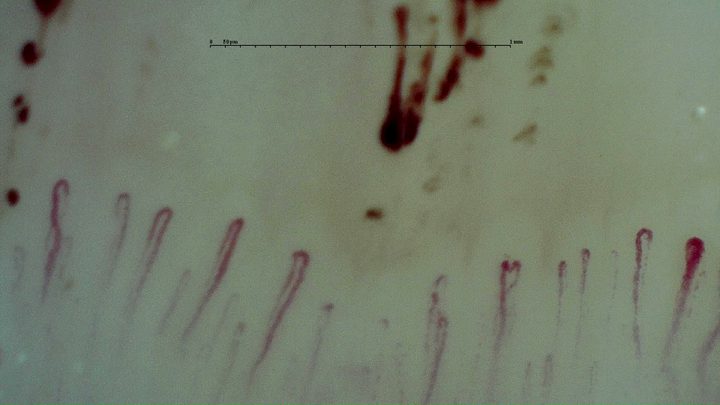 Fine hairpin capillaries with multiple dark hemorrhagic deposits, including several elongated deposits near the center-right.