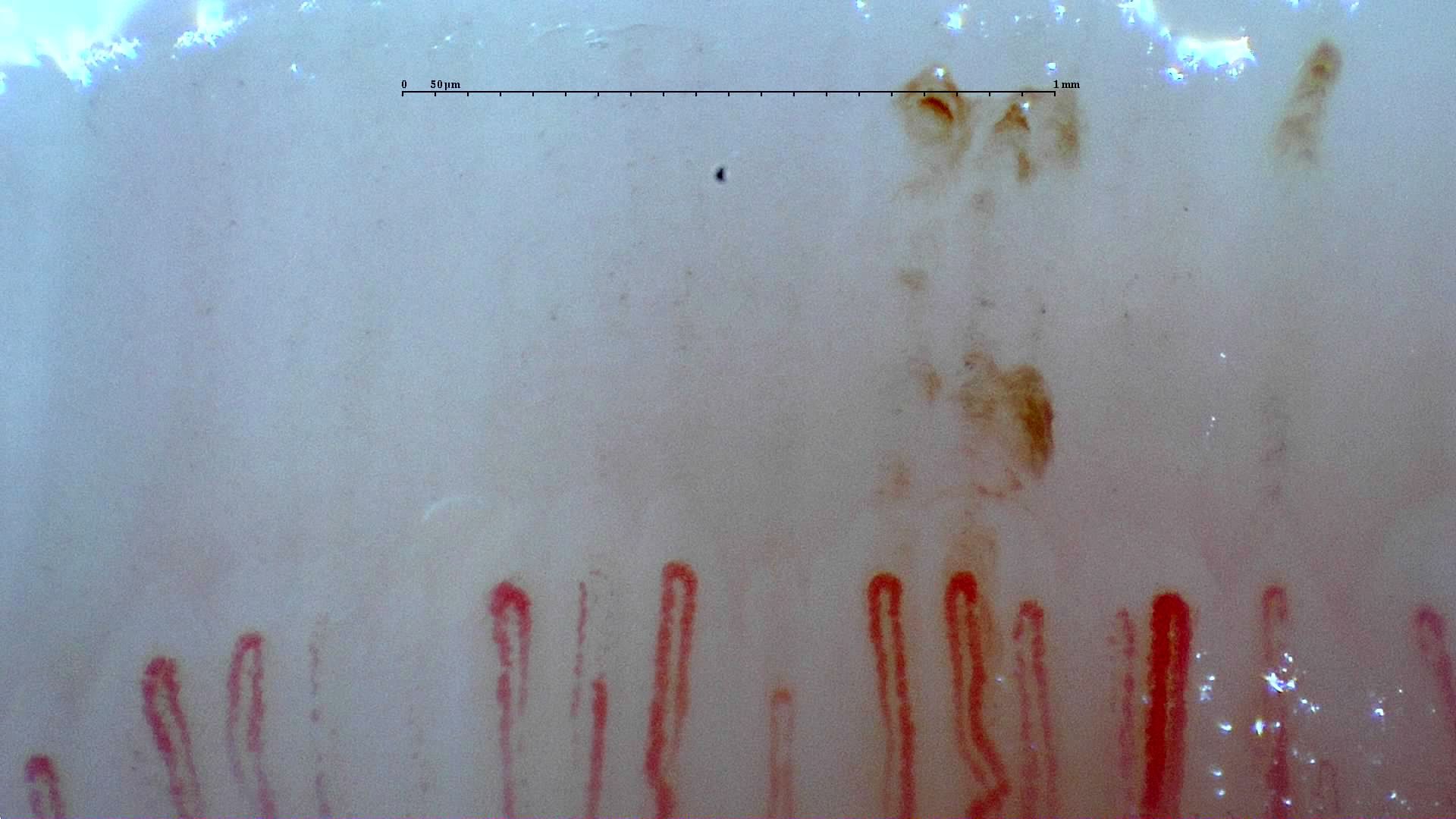 Enlarged hairpin capillaries mixed with finer loops. Irregular brown hemorrhagic deposits lie above the right side.