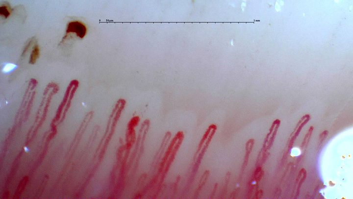 Long enlarged hairpin capillaries with a wider central apex. An irregular dark hemorrhagic deposit lies above the left side.