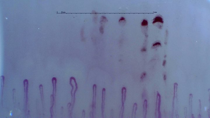 Slender rounded hairpin capillaries with mild bends. Several hemorrhagic deposits form short parallel rows above the right side.