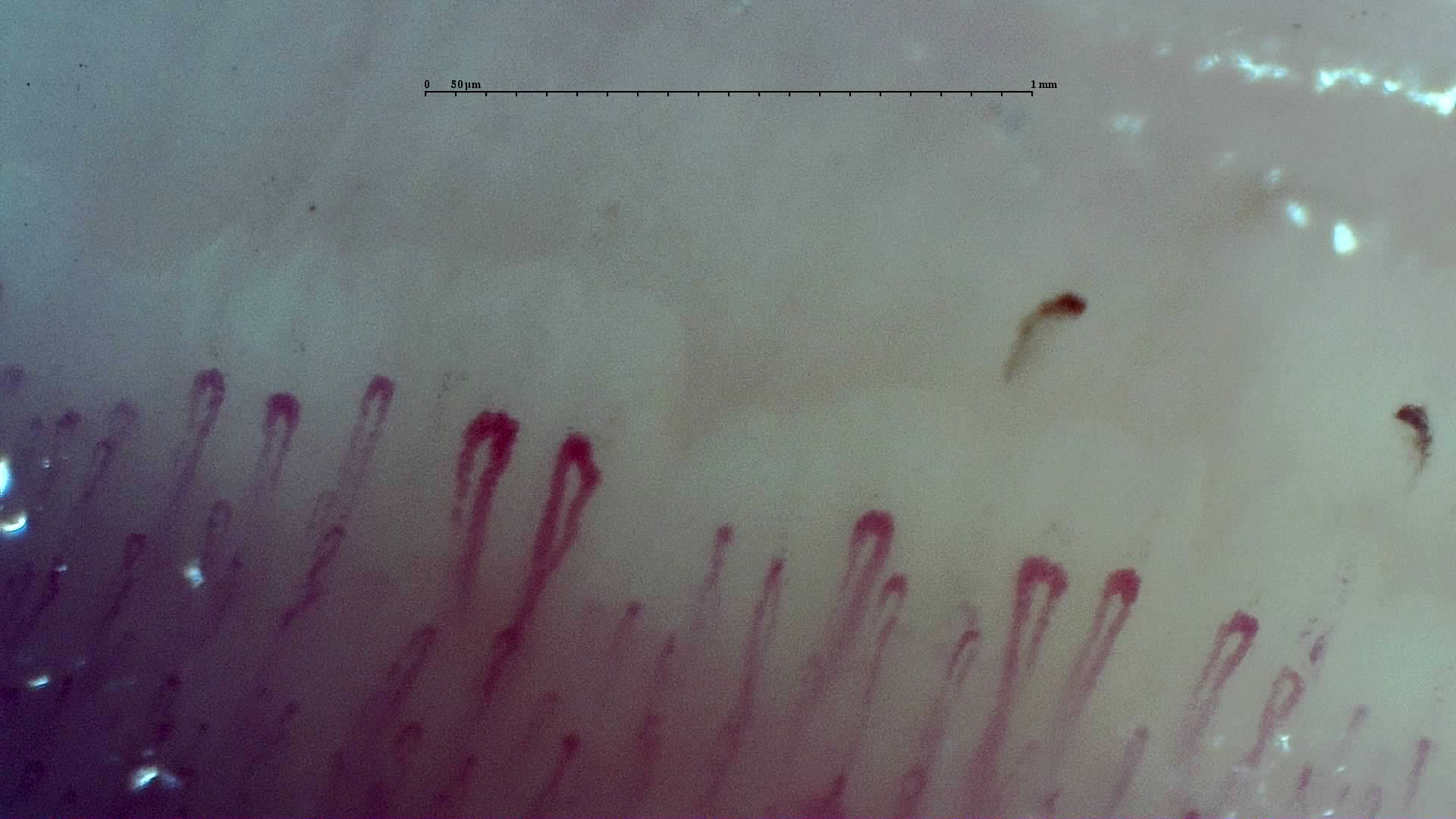 Broad hairpin capillaries beside shorter fine loops, with two small brown hemorrhagic deposits above the right half.