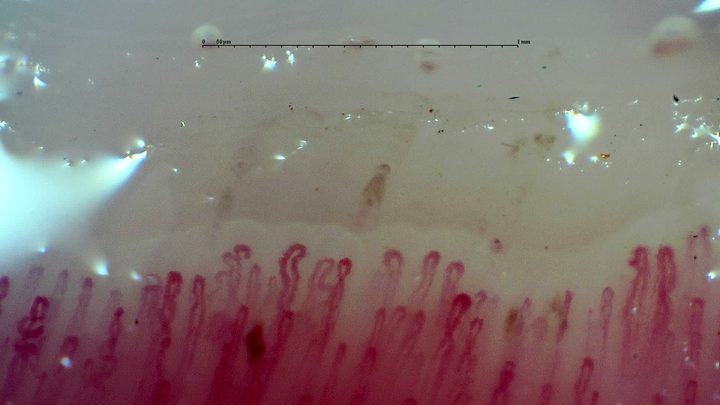 Capillaries with enlarged rounded apices and tortuous limbs. A dark red hemorrhagic focus lies among the left-central loops, with a paler deposit above.