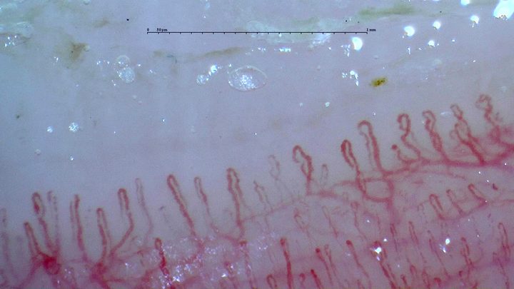 Mostly slender hairpin capillaries with mild limb curvature and a visible deeper vascular plexus.