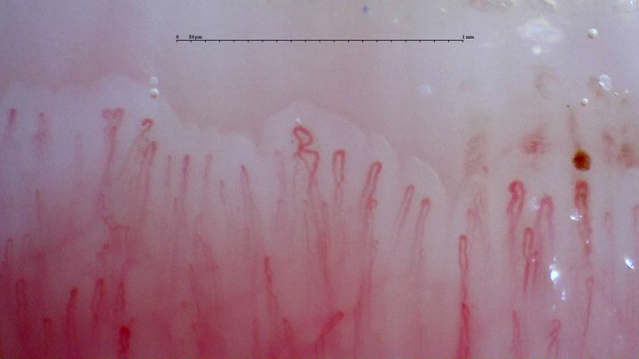 Capillaries with rounded apices, mild tortuosity and a folded central loop. A small brown-red microhemorrhage lies near the right edge.