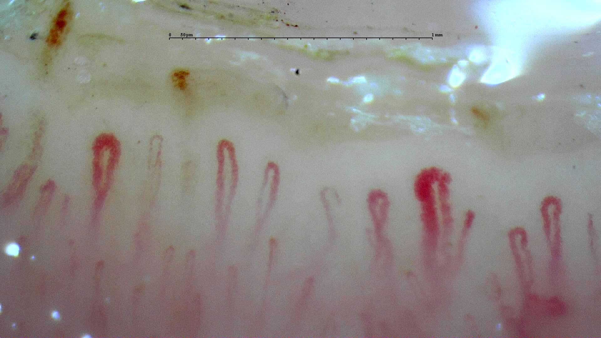 Two giant-appearing capillaries with thick rounded apices, mixed with finer loops. Brown hemorrhagic deposits lie above the row.