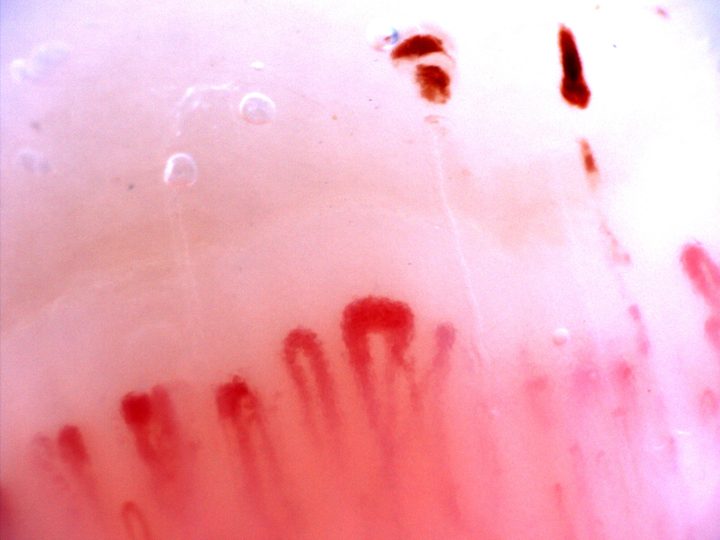 Several giant-appearing capillaries with broad rounded or angular apices. Dense dark hemorrhagic deposits lie above them.