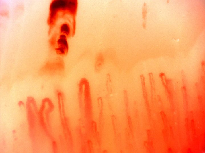 A giant-appearing capillary near the center, surrounded by narrower hairpin loops. Dense hemorrhagic deposits lie above the left side.