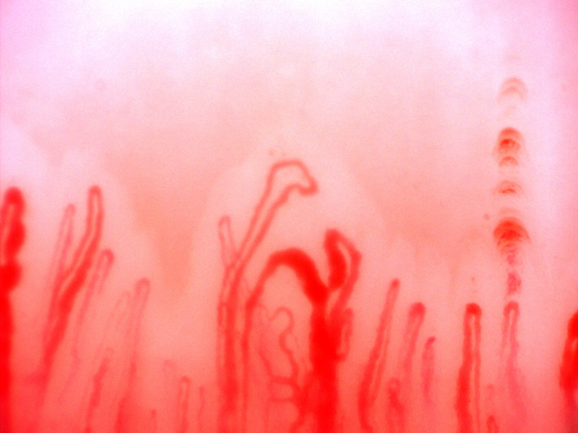A curved giant-appearing capillary near the center, beside finer and accessory loops. Reddish hemorrhagic deposits lie near the right edge.