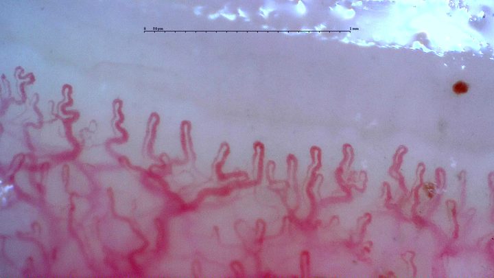 Broad tortuous capillaries with accessory loops and a visible deeper plexus. A small brown-red hemorrhagic deposit lies at the upper right.