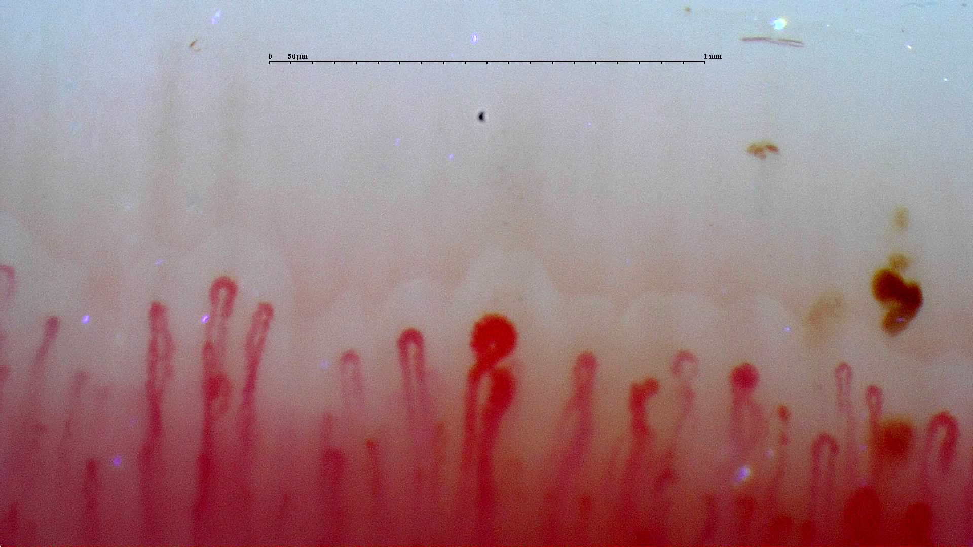 A markedly enlarged central apex and other rounded enlarged apices, beside narrower loops. Brown-red hemorrhagic deposits lie near the right edge.