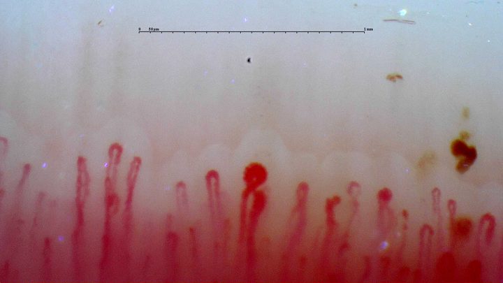 A markedly enlarged central apex and other rounded enlarged apices, beside narrower loops. Brown-red hemorrhagic deposits lie near the right edge.