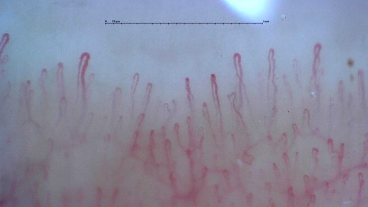Hairpin capillaries with rounded apices of different widths. The deeper vascular network is visible.