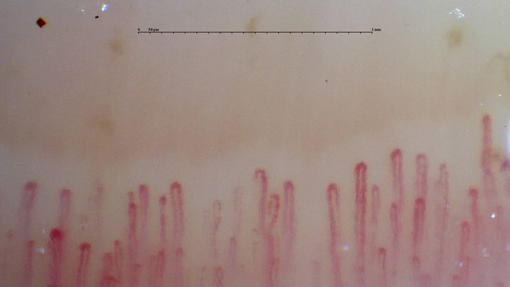 Slender hairpin capillaries with small reddish-brown deposits compatible with microhemorrhages on the left.