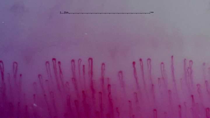 Narrow hairpin capillaries with several broader apices and occasional mild bends in the limbs.