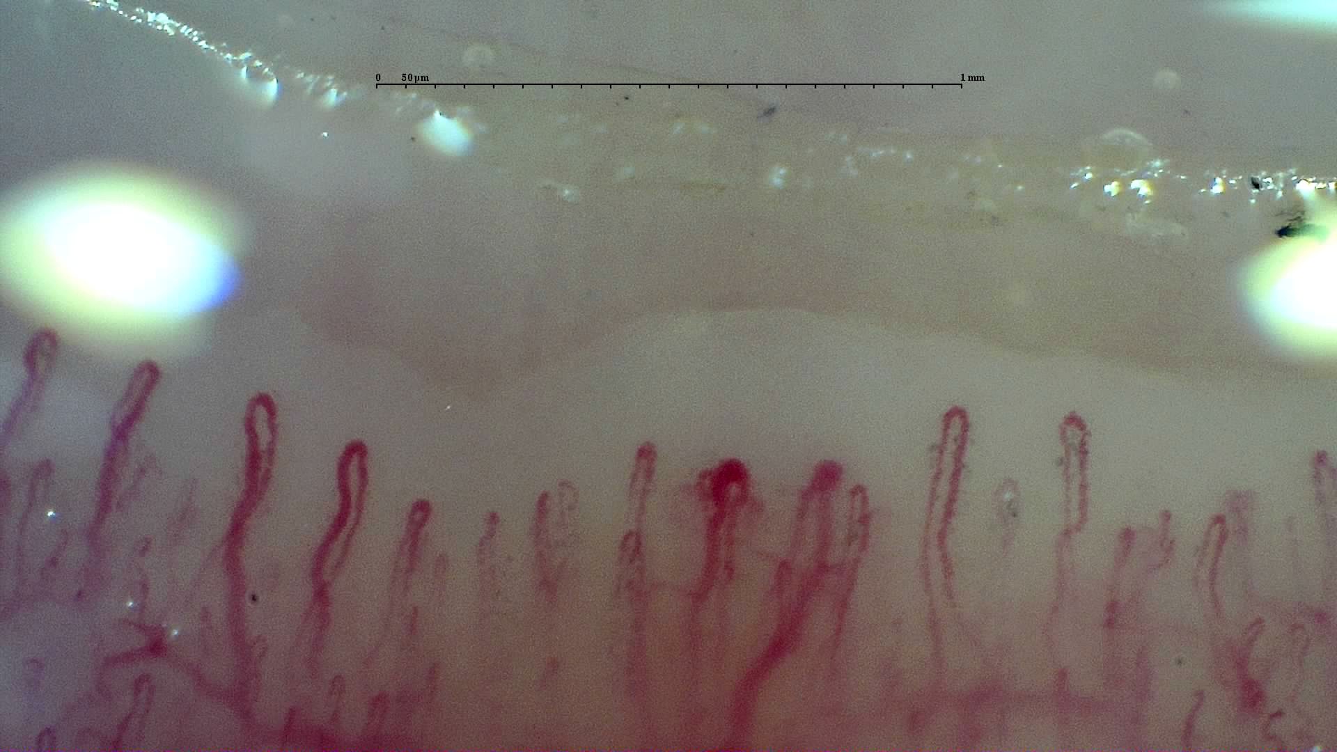 An enlarged rounded apex right of center, surrounded by narrower capillaries with mild curvature.