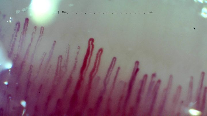 One enlarged elongated capillary near the center, with narrower hairpin loops on both sides.
