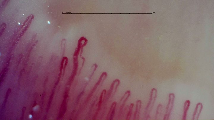 An enlarged rounded apex with a tortuous limb on the left, beside narrower hairpin capillaries.