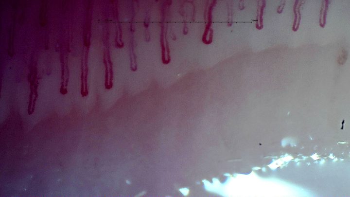 Broad elongated hairpin capillaries with mild tortuosity in some limbs.