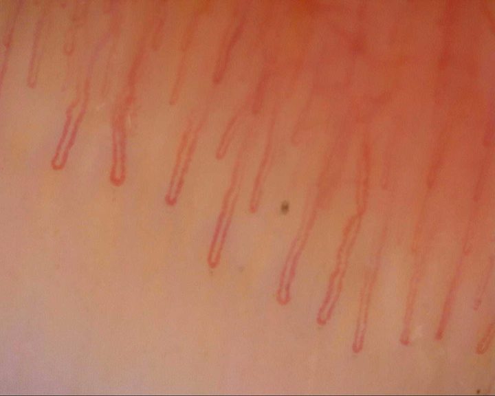 Elongated hairpin capillaries with mildly curved limbs and unequal apical widths.