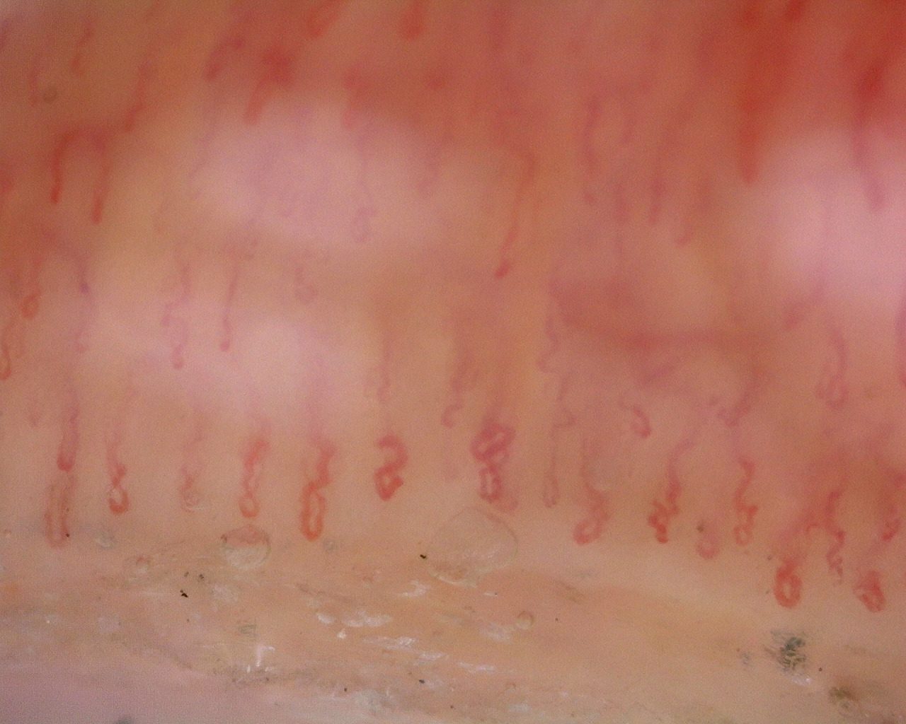 Several coiled and crossed capillaries, including figure-of-eight loops.