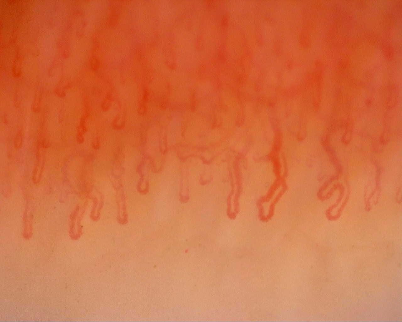 Tortuous capillaries with broad curves and a hooked loop on the right, beside narrower straight loops.