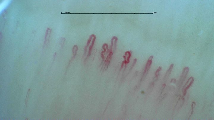 Two capillaries with irregularly curved apices in the center, between taller open hairpin loops.