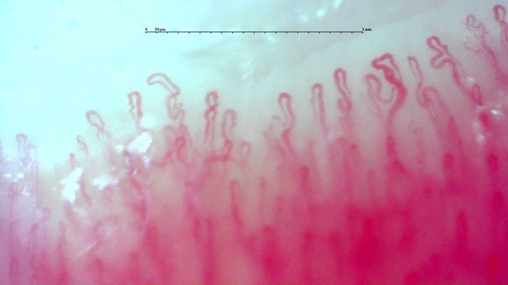 Capillaries with angular and repeatedly folded apices, especially in the right half.