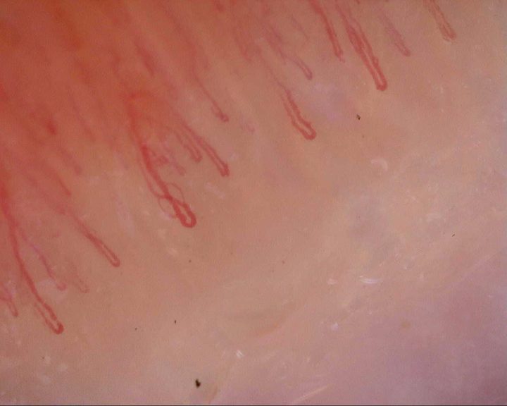 An elongated capillary with a curved limb, among finer hairpin loops with rounded apices.