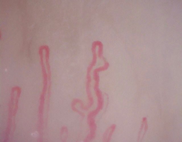 A large S-shaped capillary with a smaller lateral loop near its base, beside a simple hairpin capillary.