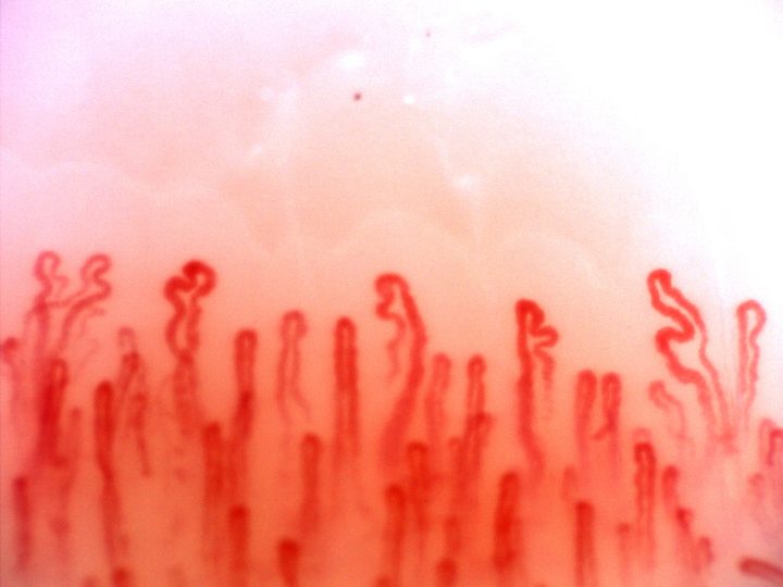 Capillaries with hooked and folded apices, beside straighter loops with parallel limbs.
