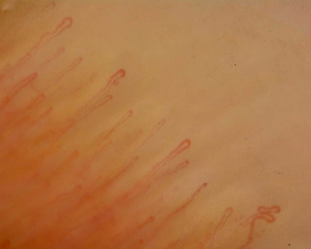Mostly fine elongated hairpin capillaries, with a small coiled loop near the lower-right edge.
