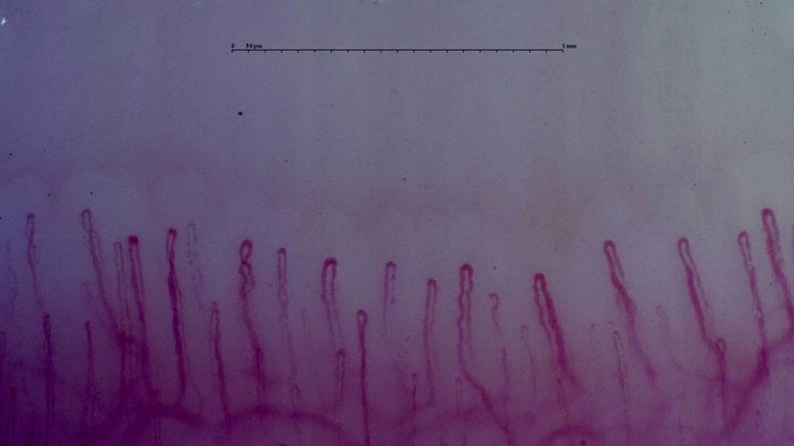 A crossed capillary left of center, among slender hairpin loops. The deeper vascular plexus is visible.
