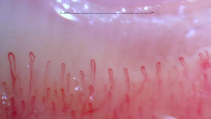 Slender capillaries with occasional angulated limbs and unequal apical widths. An irregular loop is partly visible at the right edge.