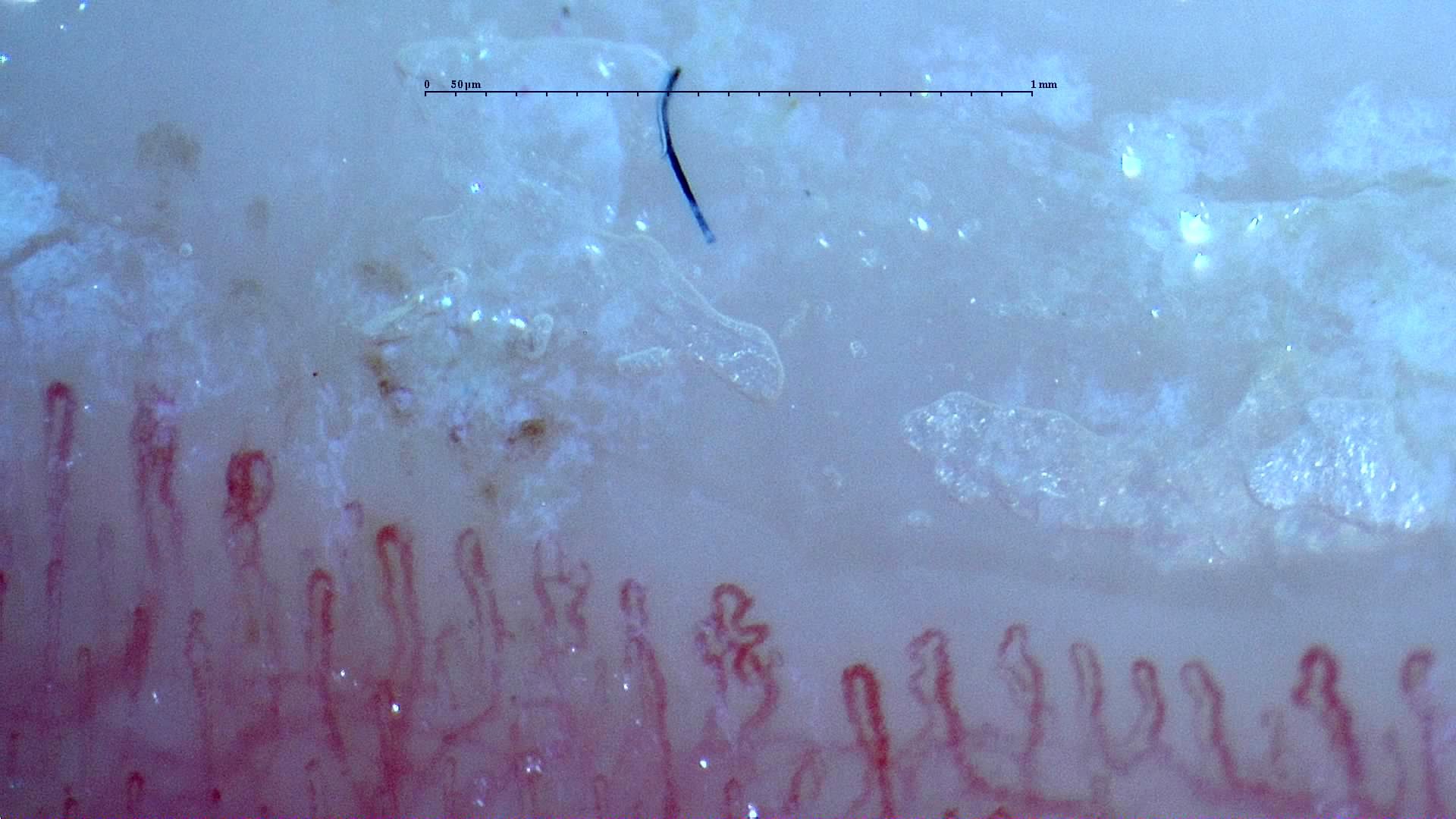 A capillary with several tight bends near the center, among shorter tortuous loops. Surface debris lies above the vessels.